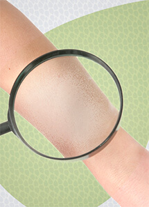 jackeline-mota-dermatologia-clinica-vitiligo-thumb